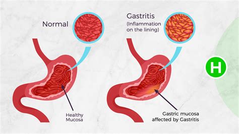gastroenteritis versus gastritis|Gastritis: Symptoms & Causes .